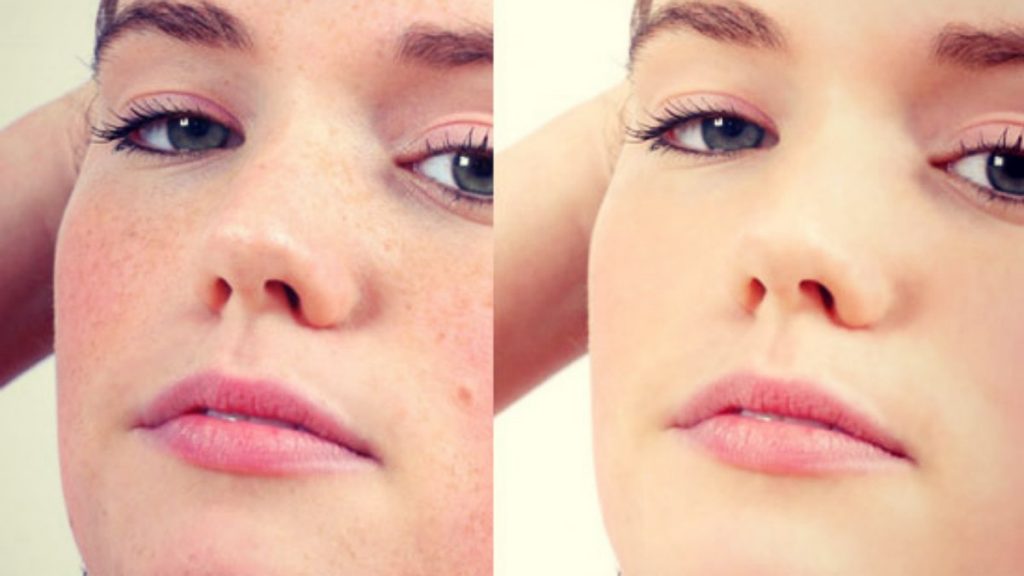 blemish free before after