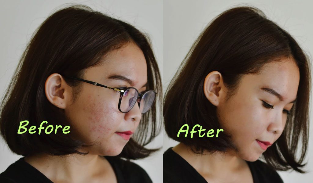 pimples on face before after