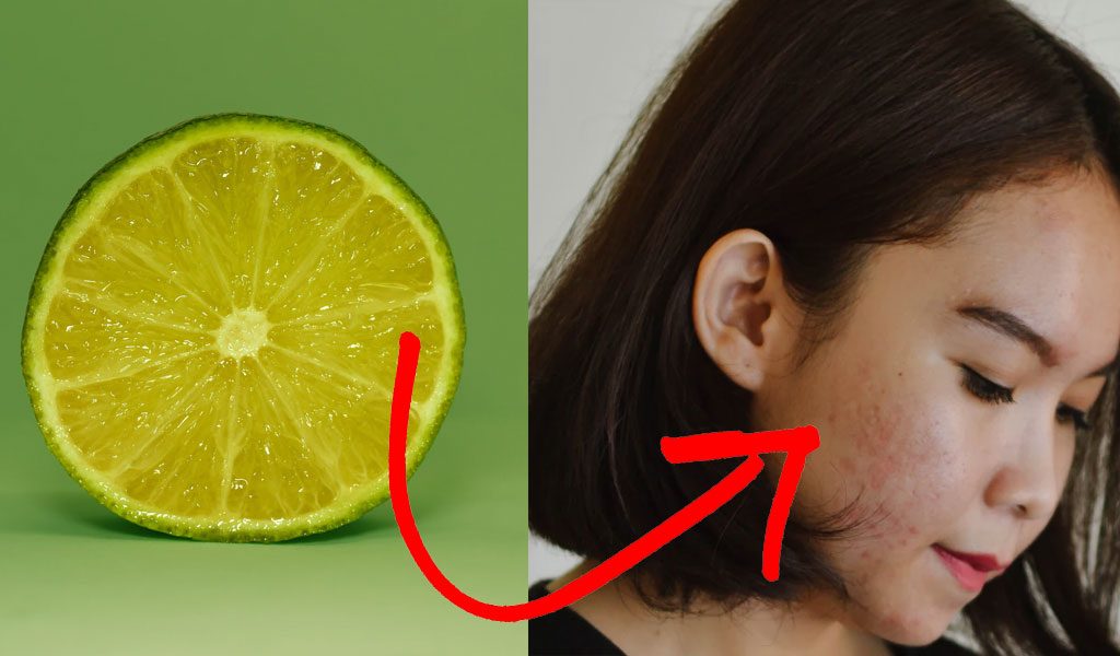 use lemon on pimples 