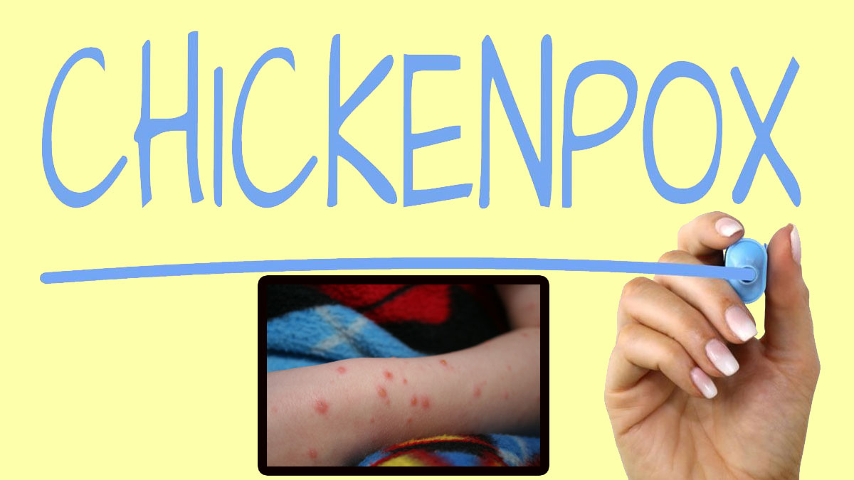 chickenpox useful tips