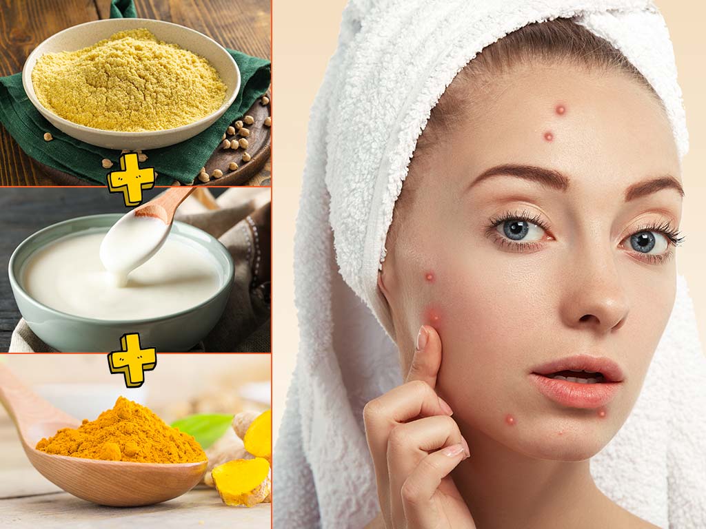 acne face pack