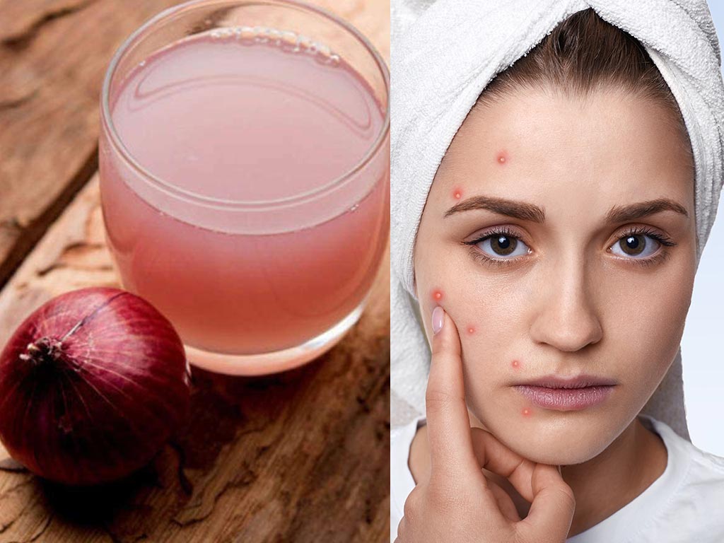 onion juice for acne spot