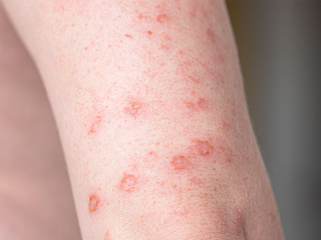 rashes