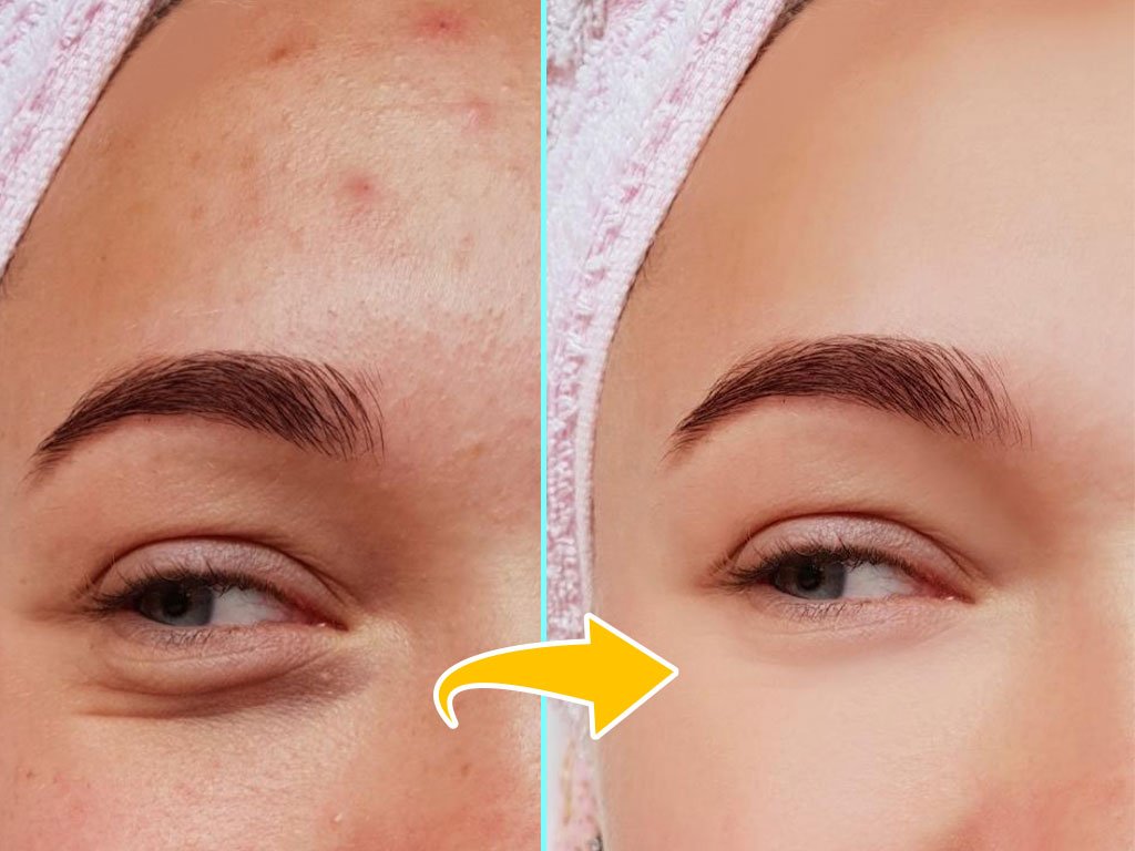 Closeup look of face before and after pimples