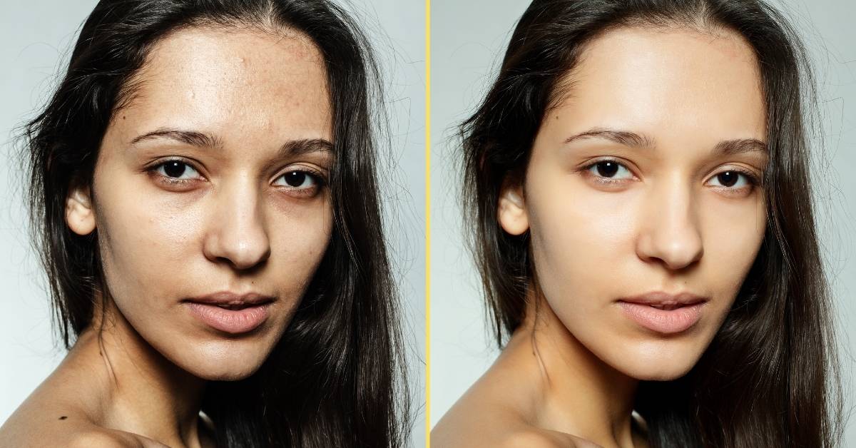 Spotless Skin Before After