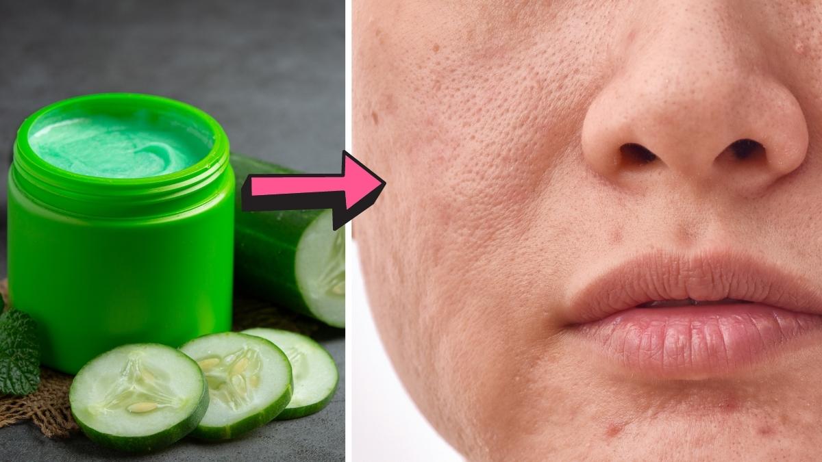 easy ways to fill acne pits