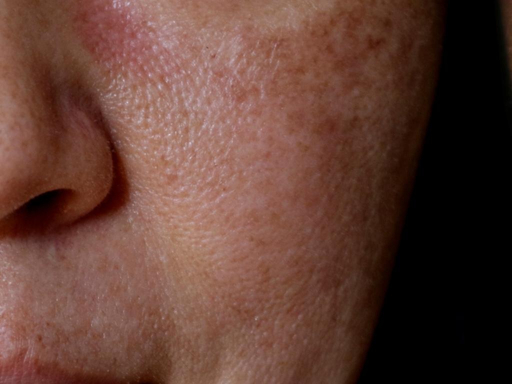 open pores on face 