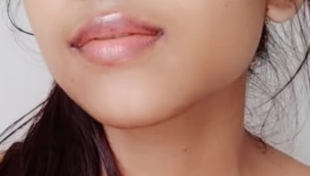 soft lip