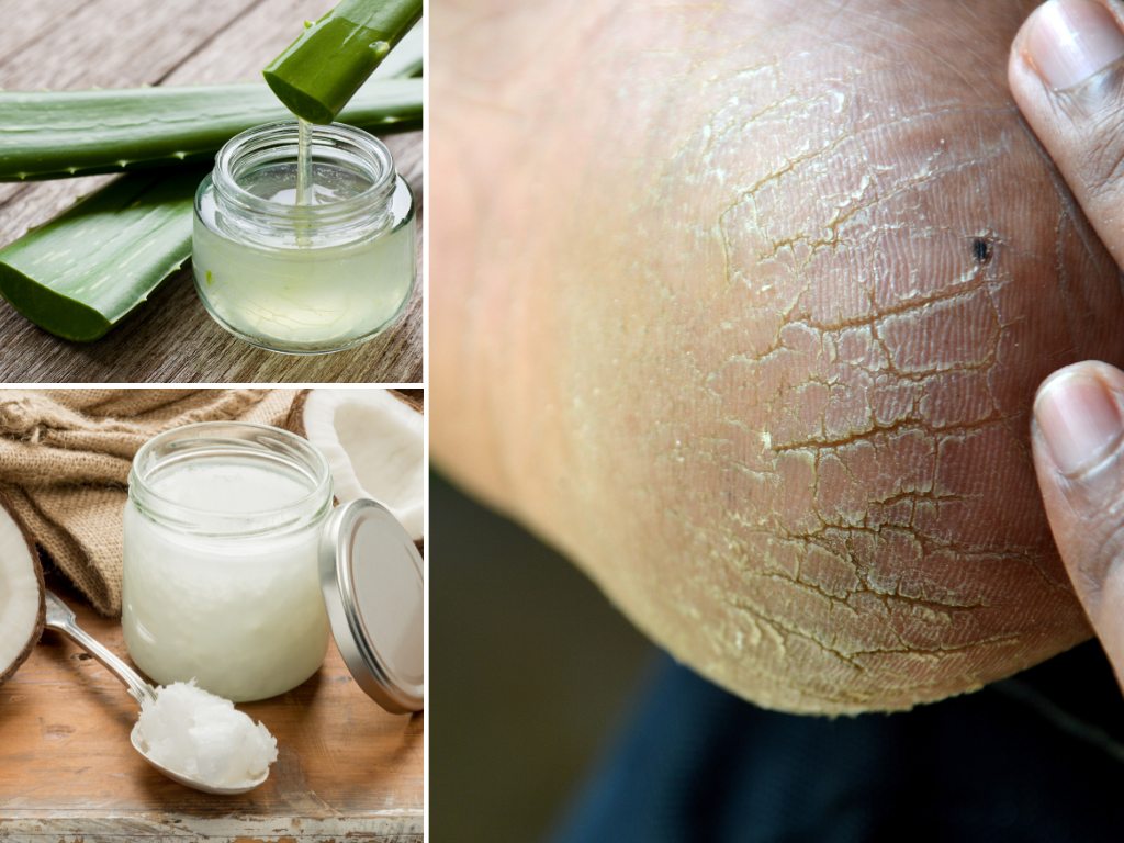 cracked heels aloe vera gel coconut oil