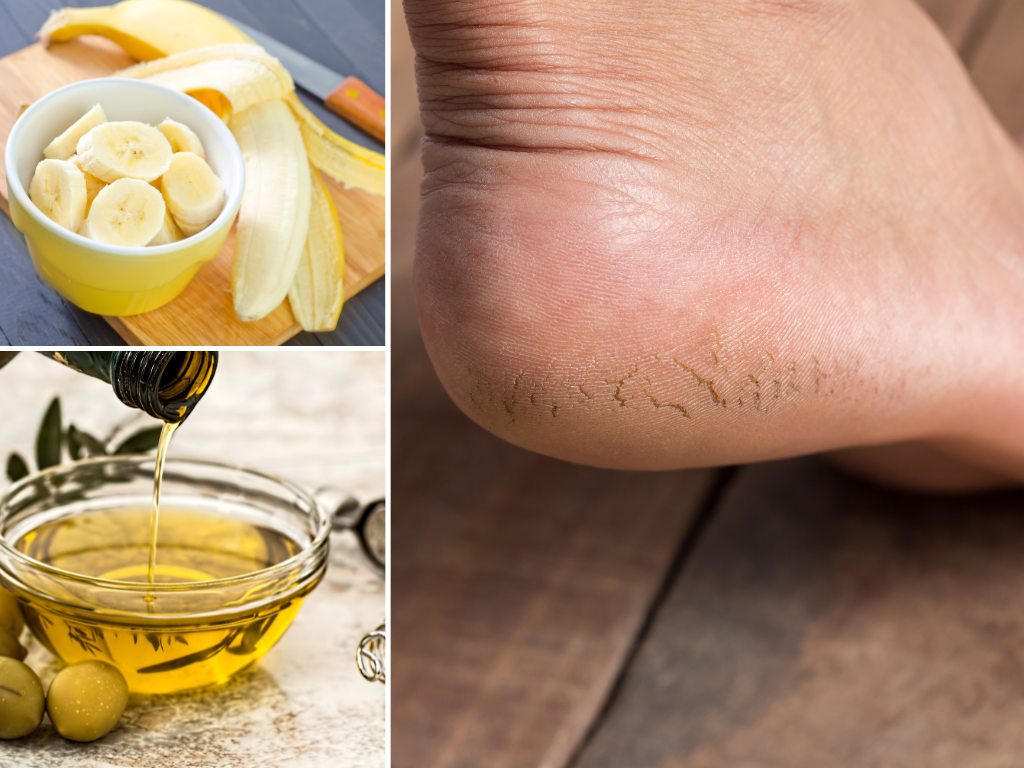 cracked heels banana olive oil